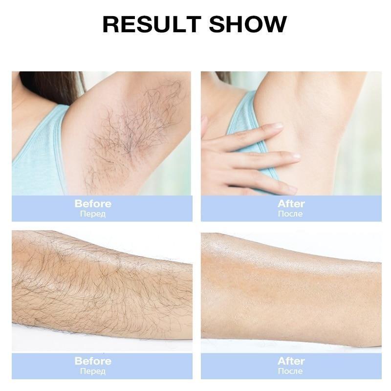 IPL Laser Hair Remover - Professional Laser Hair Remover Machine for Male and Female