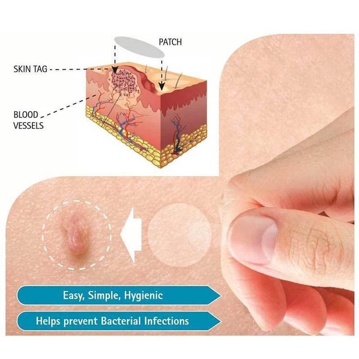 Skin Tag Remover Patch